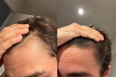 Alfavita™ Hair Regeneration System (2 months)