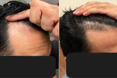 Alfavita™ Hair Regeneration System (2 months)