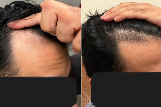 Alfavita™ Hair Regeneration System (2 months)