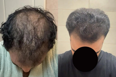 Alfavita™ Hair Regeneration System (2 months)