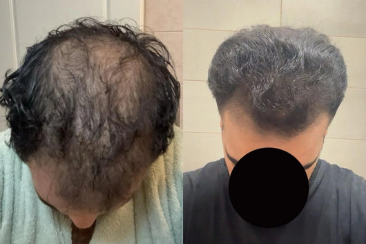 Alfavita™ Hair Regeneration System (2 months)
