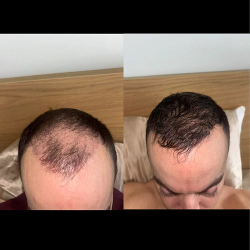 Ultimate Hair Growth Kit
