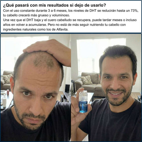 Alfavita™ Hair Regeneration System