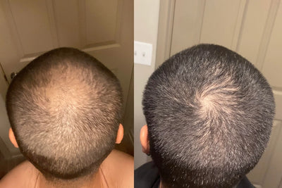 Alfavita™ Hair Regeneration System (2 months)