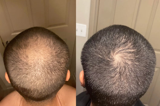 Alfavita™ Hair Regeneration System (2 months)