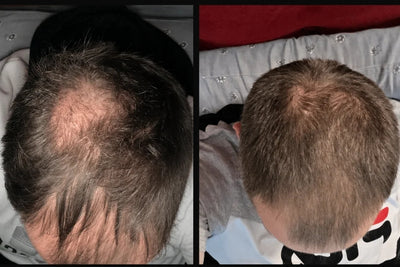 Alfavita™ Hair Regeneration System (2 months)