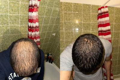 Alfavita™ Hair Regeneration System (2 months)