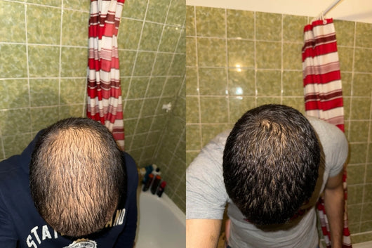 Alfavita™ Hair Regeneration System (2 months)