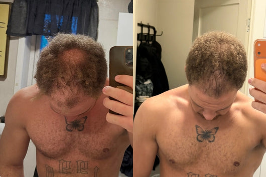 Alfavita™ Hair Regeneration System (2 months)