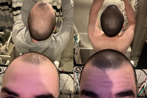 Alfavita™ Hair Regeneration System