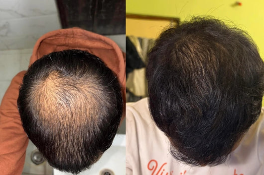 Alfavita™ Hair Regeneration System (2 months)