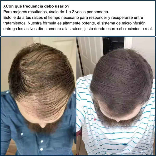 Alfavita™ Hair Regeneration System